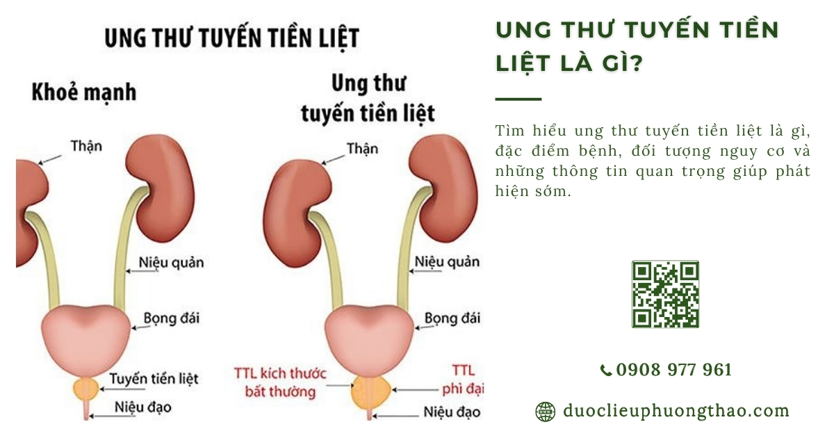 Ung thư tuyết tiền liệt là gì? Nguyên nhân, triệu chứng và cách kiểm soát an toàn cho nam giới